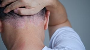 What Are The 5 Types of Psoriasis?